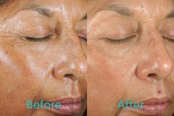 Before and After Chemical Peel