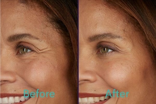 Botox Treatment Before and After