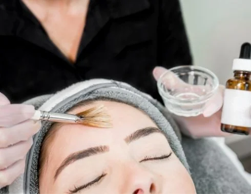 Chemical Peel Before and After