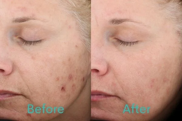 Chemical Peel Treatment Before and After