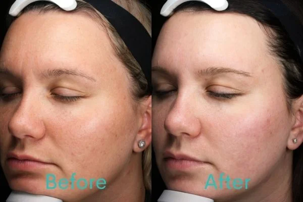 Microneedling Treatment Before and After