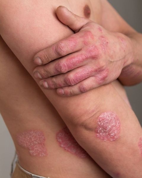 Psoriasis