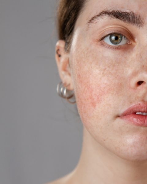 Rosacea