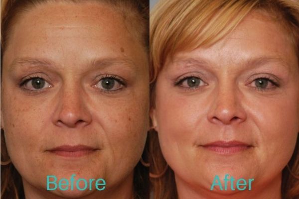 BBL Photofacial before and after