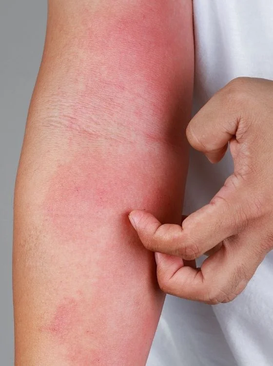 Eczema Treatment