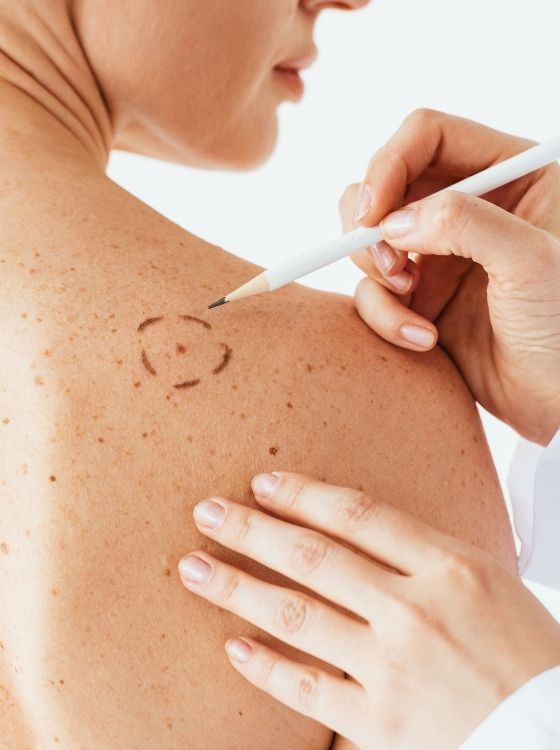 Melanoma-Abnormal-Moles