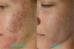 Microneedling Before After