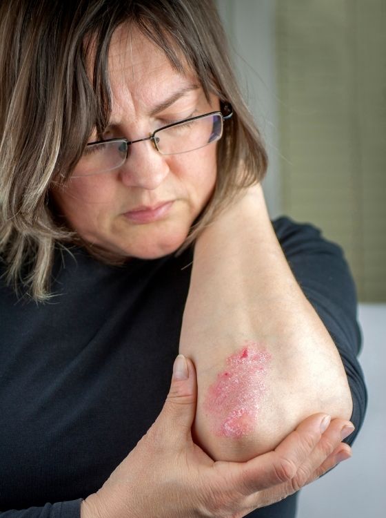 Psoriasis on Elbow