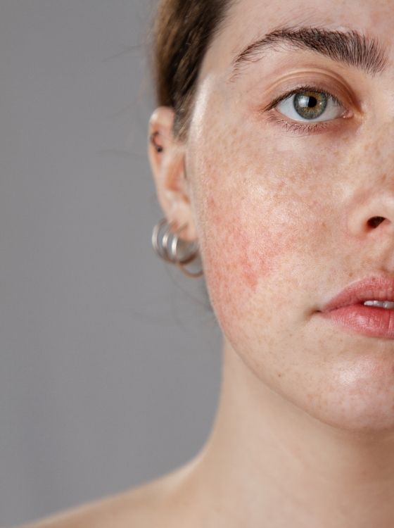 Rosacea on Face