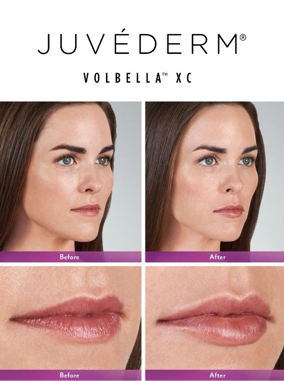 Volbella Before and After