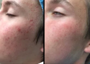 Vbeam Before After Face