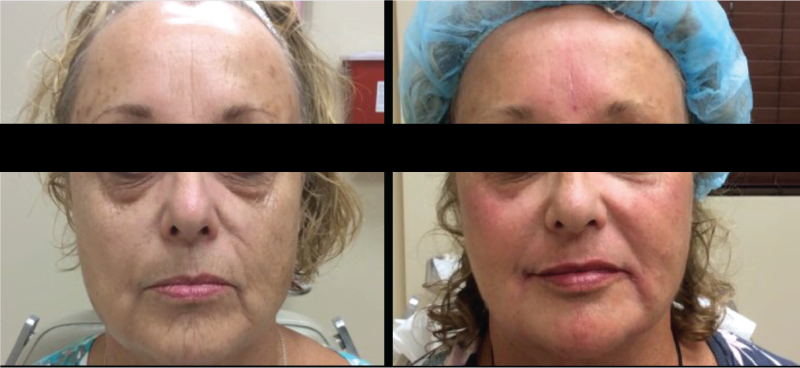 Filler Before and After Dermatology Center of Atlanta_B