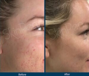 SkinPen Microneedling Treatment Before and After