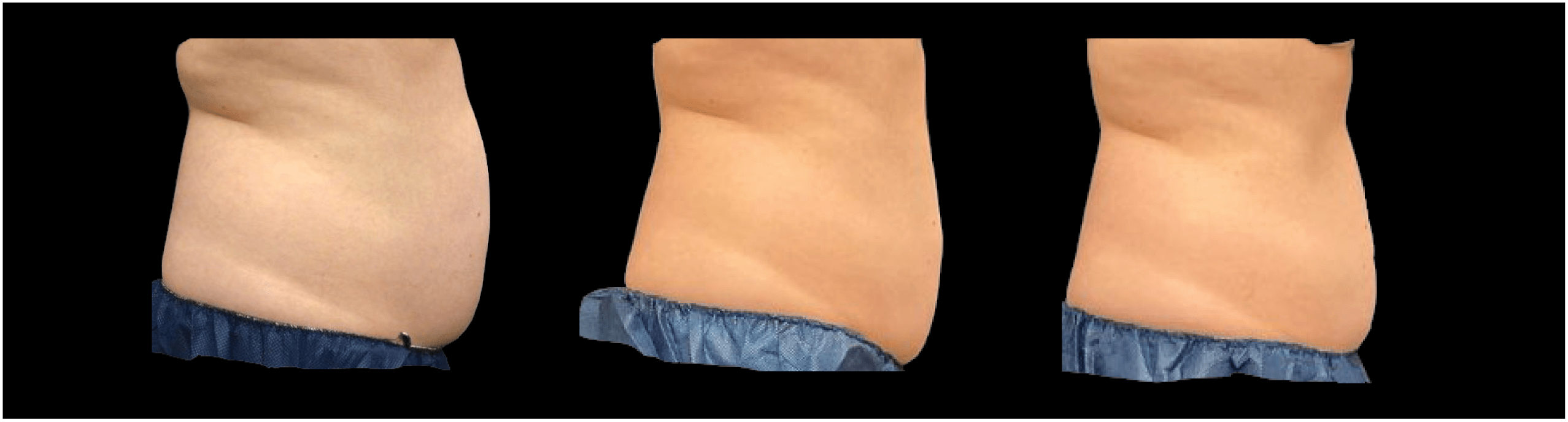 CoolSculpting Elite Before During After DJ side view