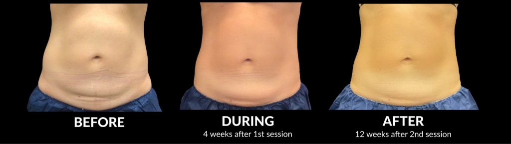 CoolSculpting Elite Before During After