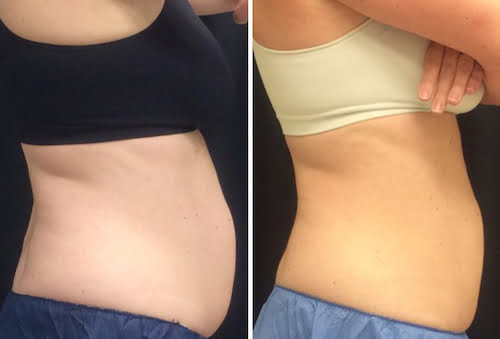 12 weeks after one session with CoolSculpting Elite