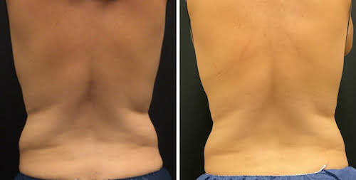 CoolSculpting Elite Before and After - flanks