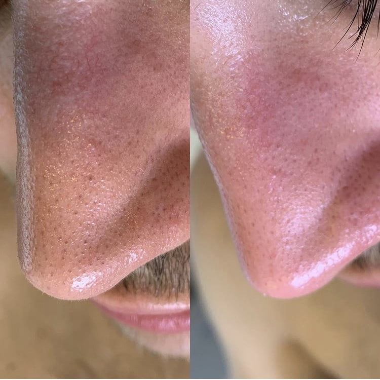 Hydrafacial Before After Nose