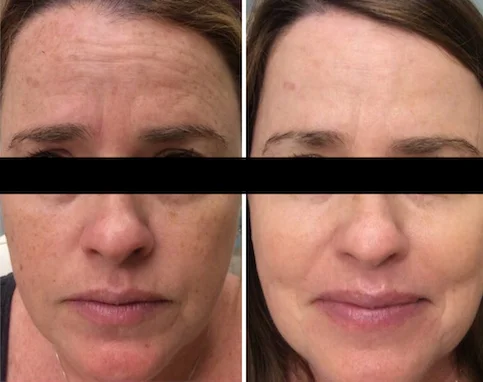 Laser Skin Rejuvenation Before And After - Dermatology Center Of Atlanta