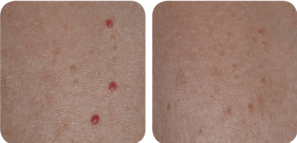 Vbeam before after cherry angioma