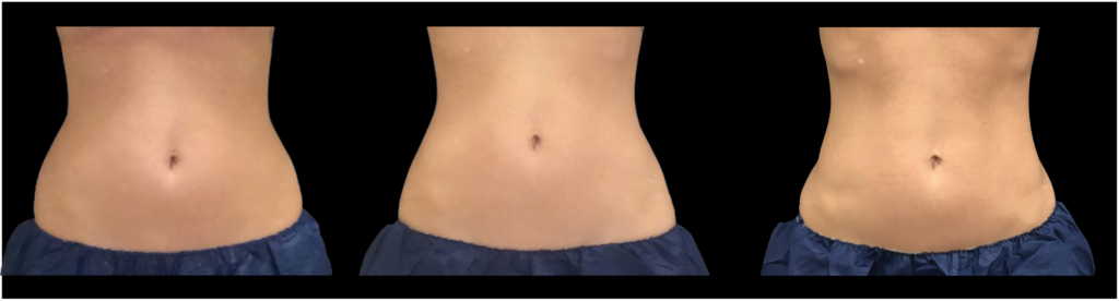 CoolSculpting and CoolTone