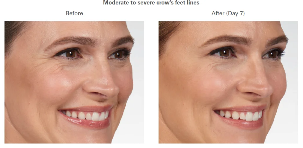 Botox Before and After Crow's Feet