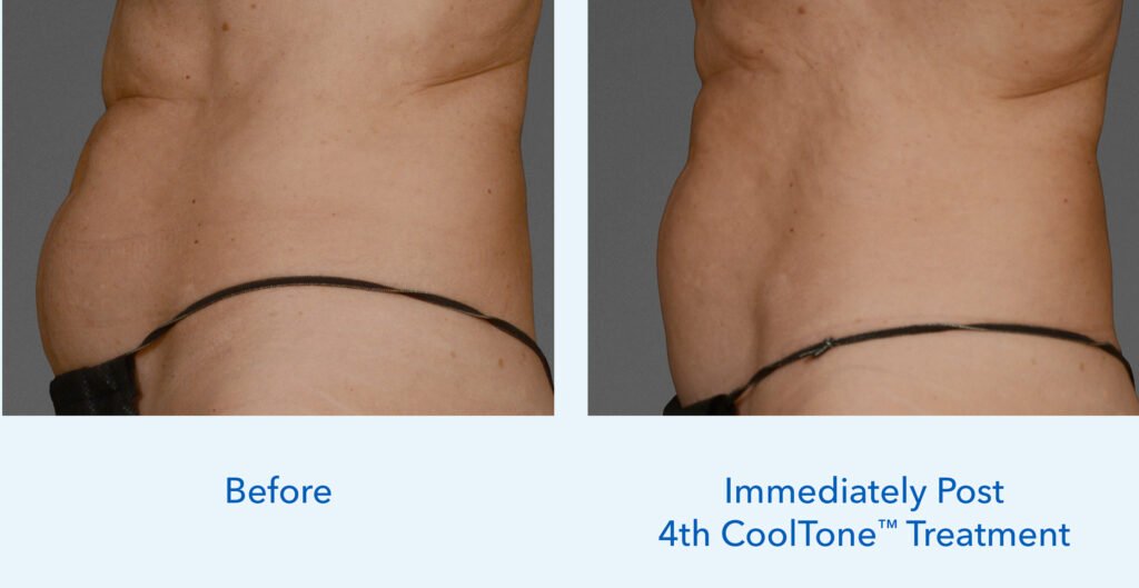 CoolTone before and after abdomen