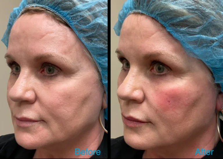 Filler Before After Kris