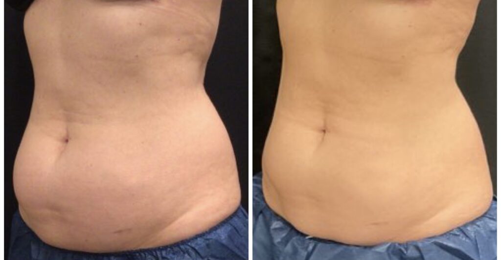 Before After CoolSculpting two sessions