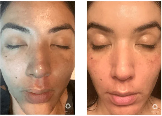 PDP Peel Before After Front