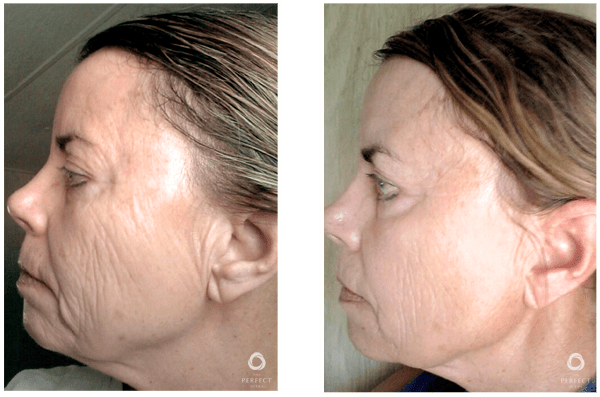 Chemical Peel Before and After - Dermatology Center of Atlanta