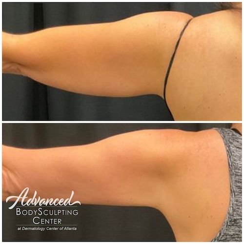 CoolSculpting Before and After 2