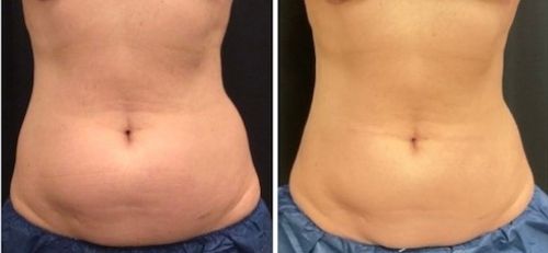 CoolSculpting Before and After 4