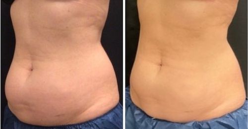CoolSculpting Before and After 5