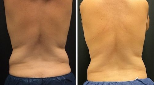 CoolSculpting Before and After 6