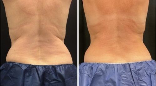 CoolSculpting Before and After 7