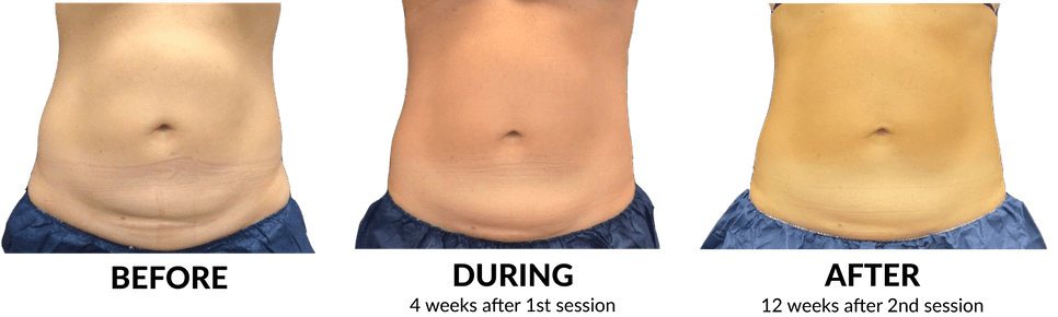 CoolSculpting_Before and After