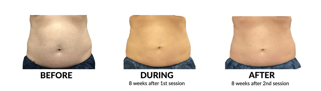 Before and After CoolSculpting