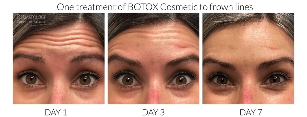 Botox Before and After One treatment Dermatology Center of Atlanta days 1 through 7