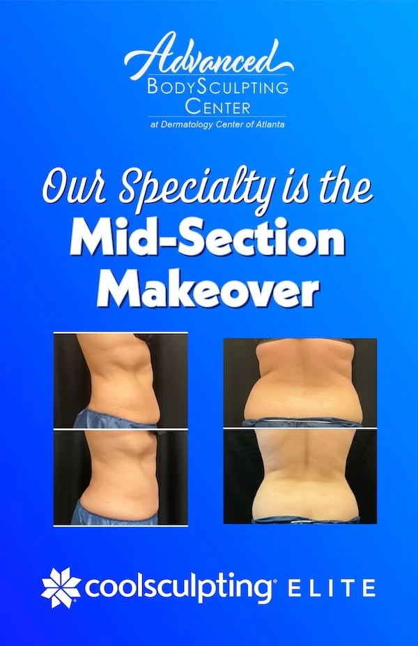 CoolSculpting Flanks (Love Handles) Before & After Photos - Cosmetic -  Ark-La-Tex Dermatology & Medical Spa - Louisiana - A Part of the  Willis-Knighton Physician Network