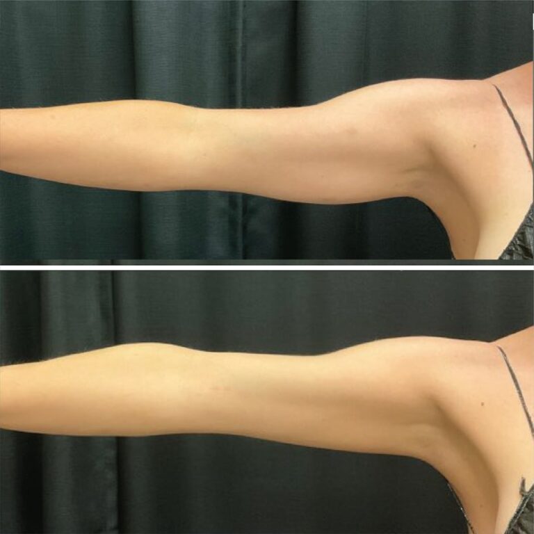 CoolSculpting Elite Before After Arms Advanced Bodysculpting Center