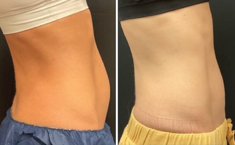 CoolTone Before After Abdomen side view advanced bodysculpting center