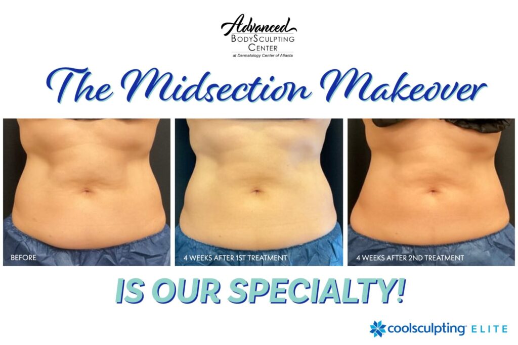 Midsection Makeover Specialty Advanced BodySculpting Center Before During After Dermatology Center of Atlanta-b