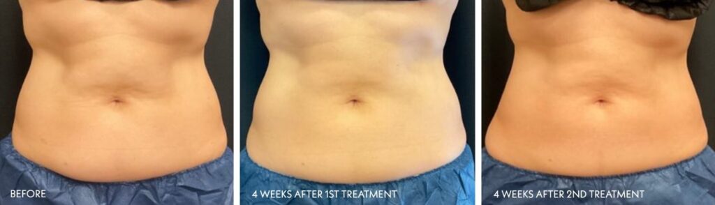 MidSection Makeover Abdomen Before During After