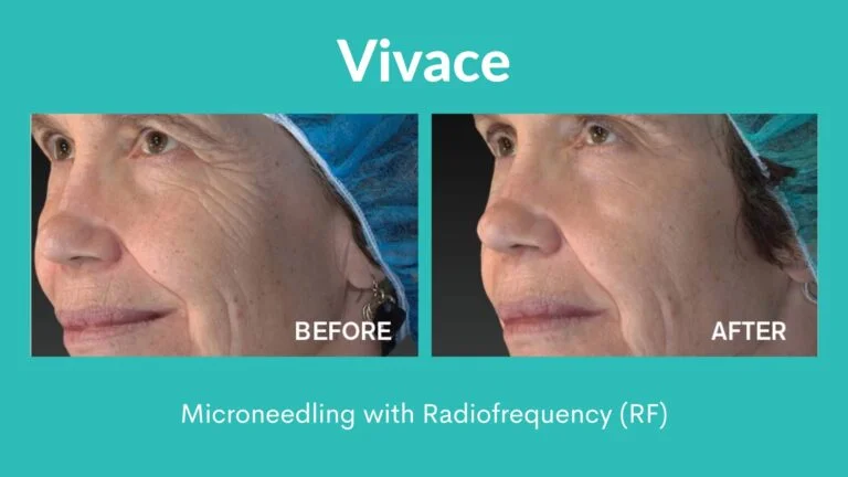 Vivace Microneedling with radio frequency Before and After