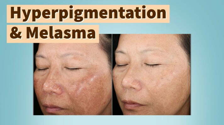 How to treat hyperpigmentation and melasma