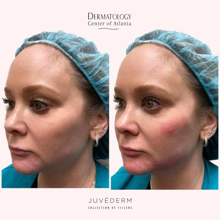DCA Juvederm Volux Before After Des