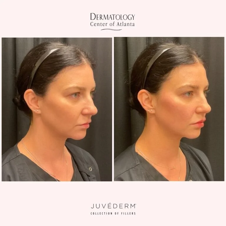 DCA Juvederm Volux Before After Amber