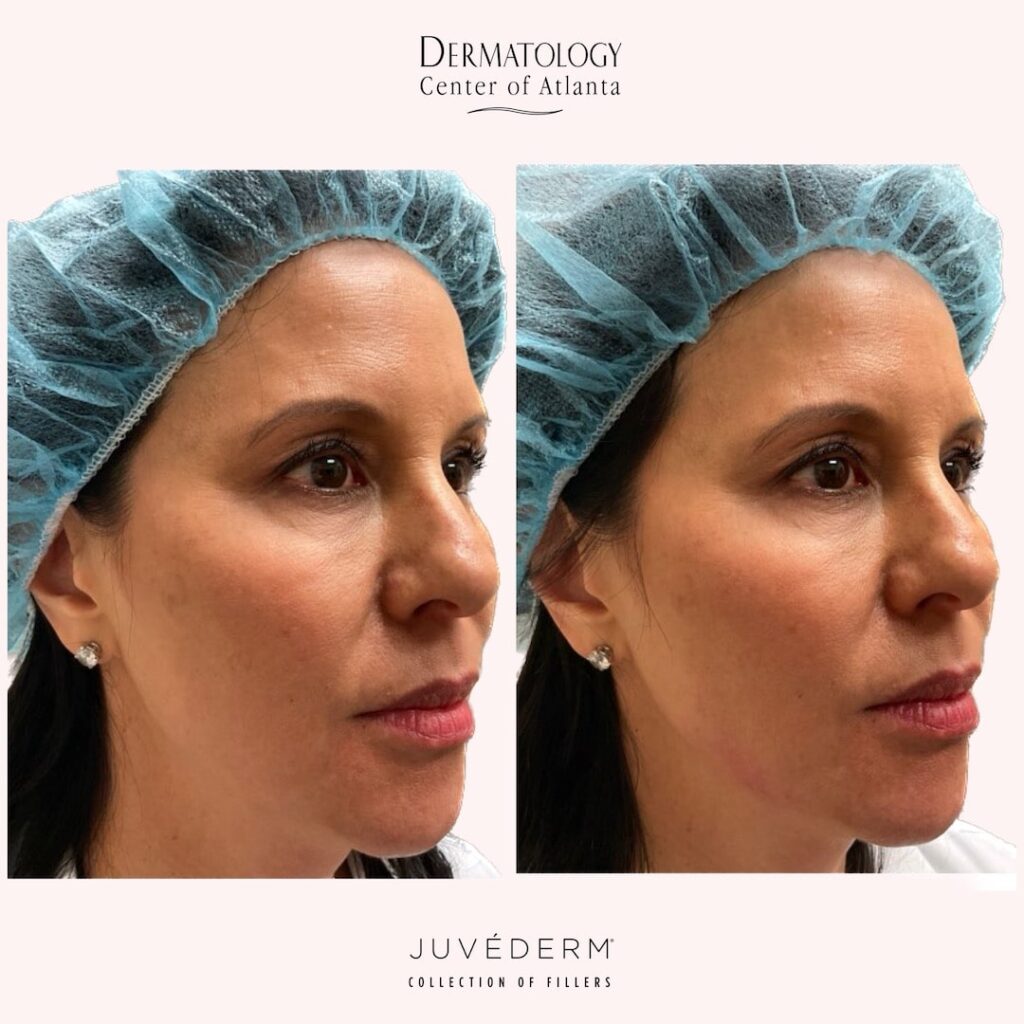 DCA Juvederm Volux Before After LG