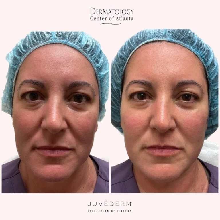 DCA Juvederm Volux Before After Scarlett